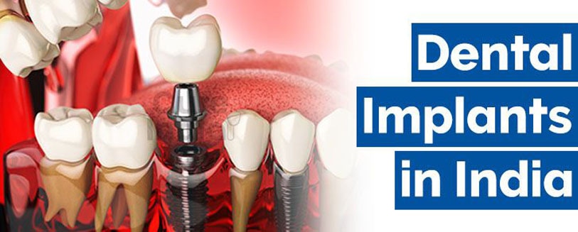 Dental Implants in India